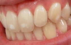 روش‌هایی برای رهایی از لکه‌های سفید دندان‌