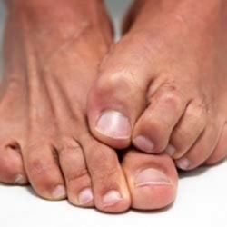 درمان‌های خانگی برای قارچ ناخن‌ پا