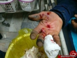 انفجار موادمحترقه انگشتان کودکی را قطع کرد