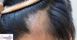 آیا روش‌های درمان ریزش‌ مو مؤثرند؟