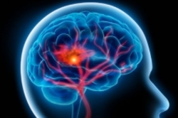 پایین بودن سطح کلسترول و خطر سکته مغزی