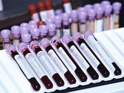 جداسازی پلاسمای بهبودیافتگان کرونا برای تزریق به مبتلایان   اعلام نتایج تا ۲ هفته آینده