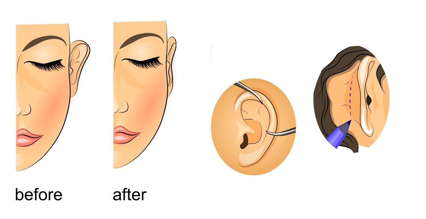 اصلاح فرم بد گوشها با جراحی زیبایی گوش امکان پذیر است! اصلاح فرم بد گوشها با جراحی زیبایی گوش امکان پذیر است!