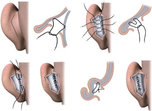 اصلاح فرم بد گوشها با جراحی زیبایی گوش امکان پذیر است! اصلاح فرم بد گوشها با جراحی زیبایی گوش امکان پذیر است!