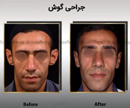 اصلاح فرم بد گوشها با جراحی زیبایی گوش امکان پذیر است! اصلاح فرم بد گوشها با جراحی زیبایی گوش امکان پذیر است!