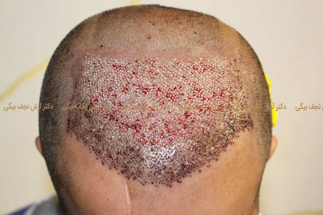 بهبود طاسی و کم پشت بودن موی سر بهبود طاسی و کم پشت بودن موی سر