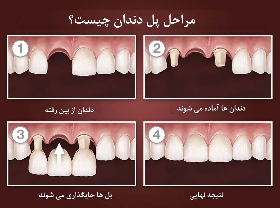 5 روش برای جایگزینی دندان های از دست رفته