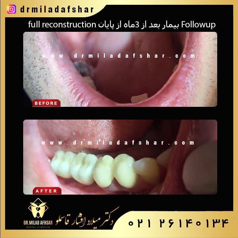 5 روش برای جایگزینی دندان های از دست رفته