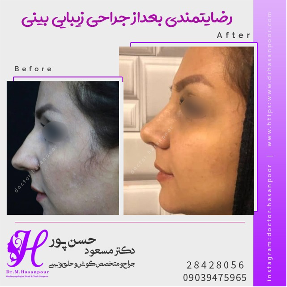 همه چیز درباره جراحی بینی استخوانی همه چیز درباره جراحی بینی استخوانی