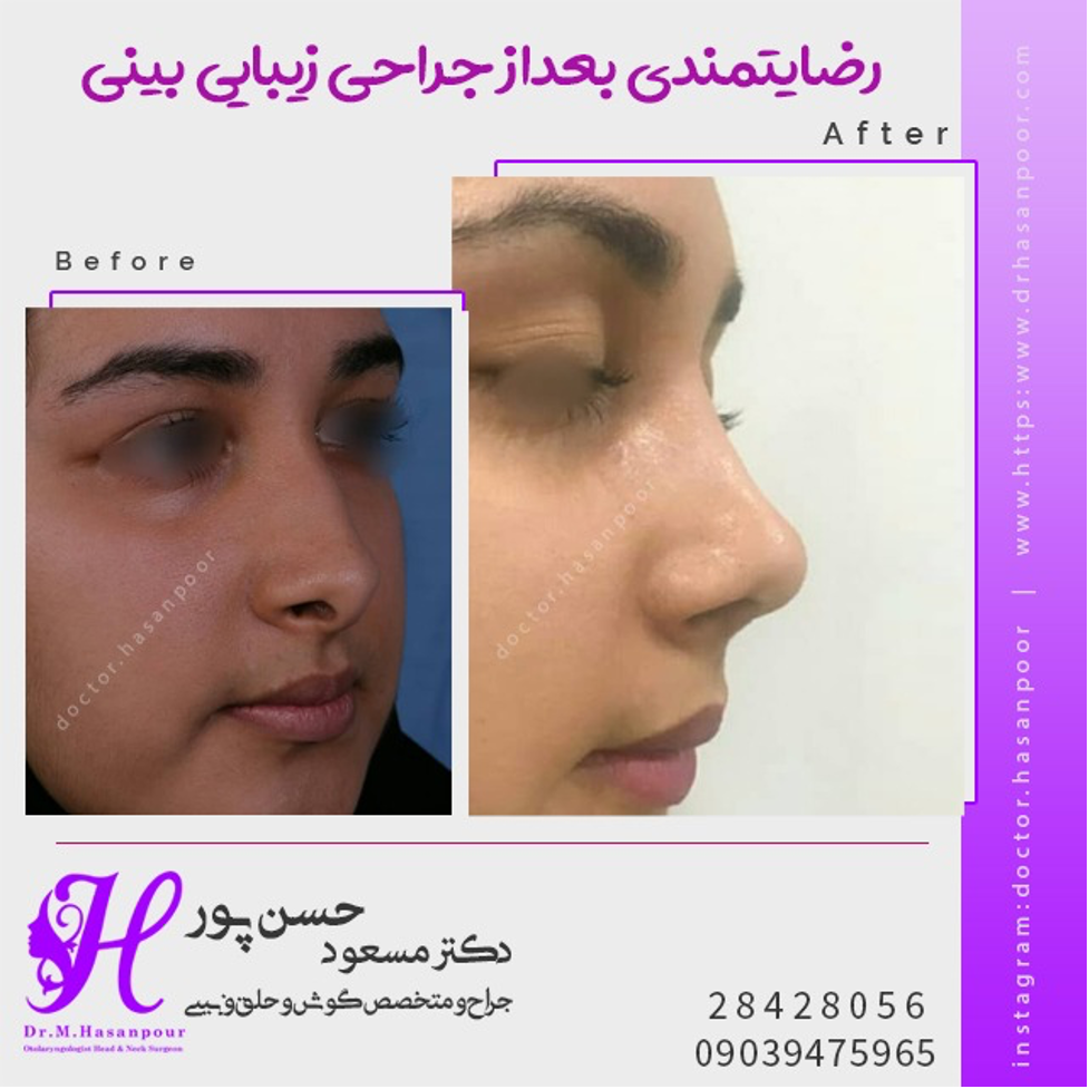 همه چیز درباره جراحی بینی استخوانی همه چیز درباره جراحی بینی استخوانی