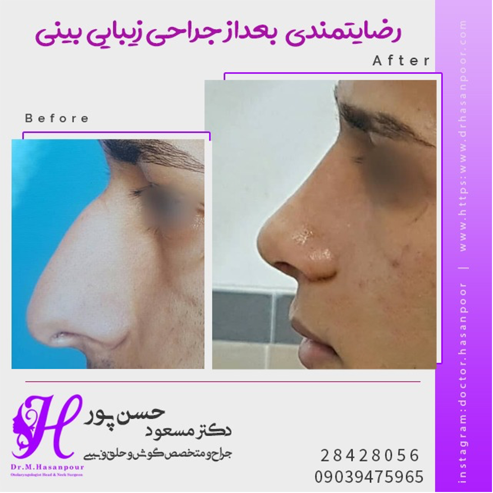 همه چیز درباره جراحی بینی استخوانی همه چیز درباره جراحی بینی استخوانی