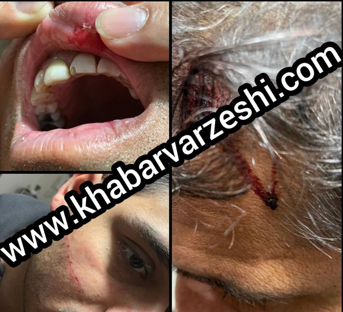 تصاویر دلخراش از ضرب و شتم پیشکسوت پرسپولیس و استقلال/ سر و دندان خودم را شکستند و صورت و سینه پسرم مجروح شد