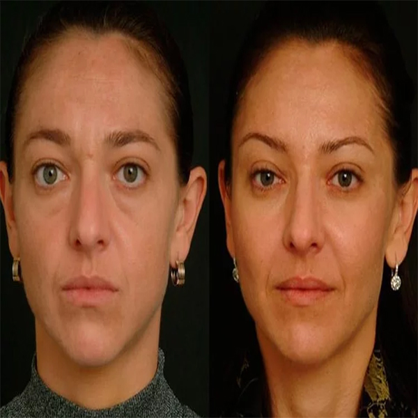 همه چیز درباره تزریق چربی