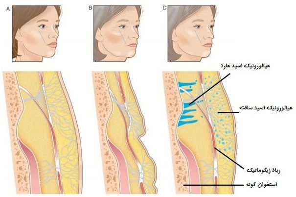 فیلر گونه و فرم های تزریق آن فیلر گونه و فرم های تزریق آن