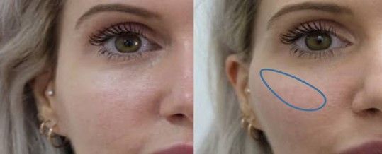 فیلر گونه و فرم های تزریق آن فیلر گونه و فرم های تزریق آن