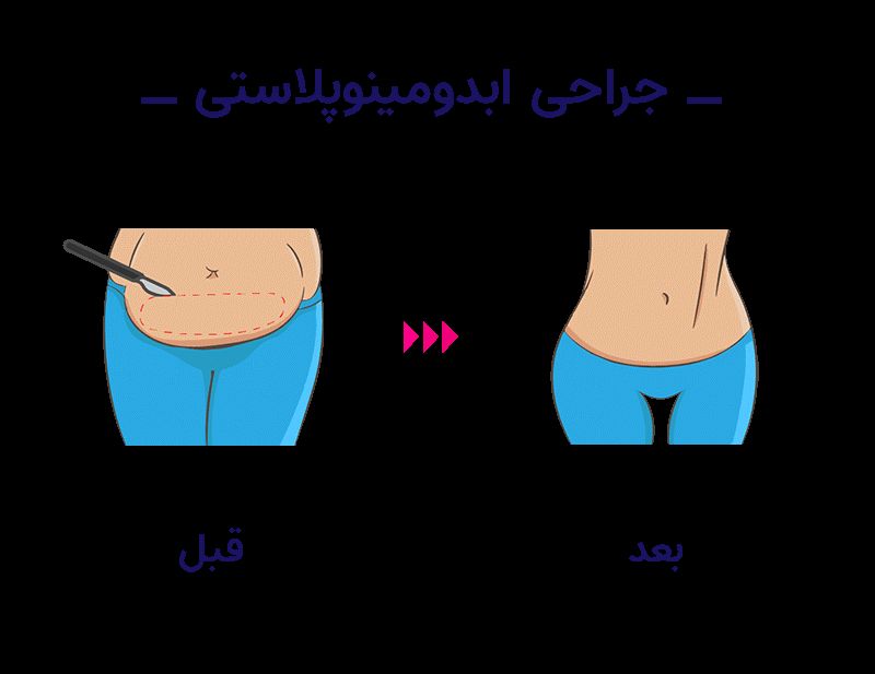 عمل لاغری برای تناسب اندام با ویکی درمان عمل لاغری برای تناسب اندام با ویکی درمان