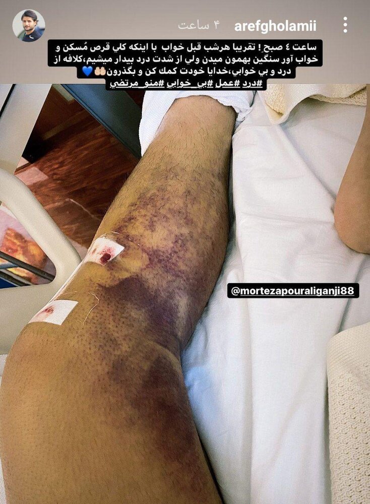 وضعیت عجیب پای عارف غلامی/عکس
