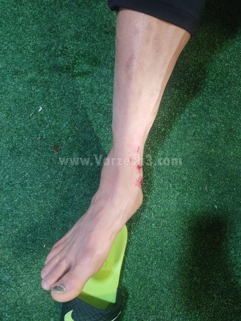 وضعیت مصدومیت دانیال اسماعیلی‌فر+عکس