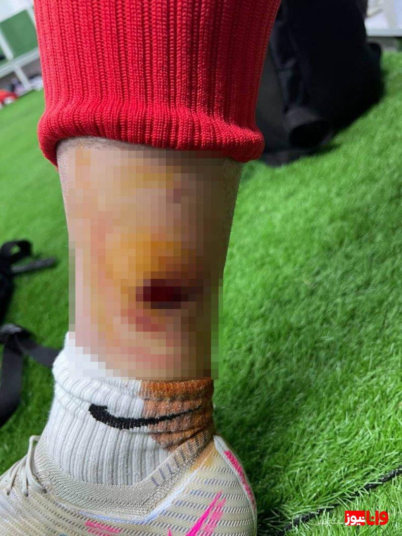 نارنجکی که روی پای مدافع پرسپولیس ترکید! (عکس)