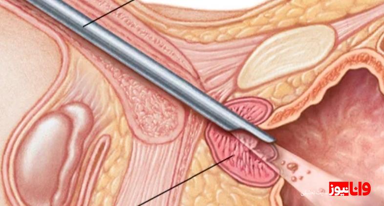 چه زمانی باید پروستات را عمل کرد؟ چه زمانی باید پروستات را عمل کرد؟