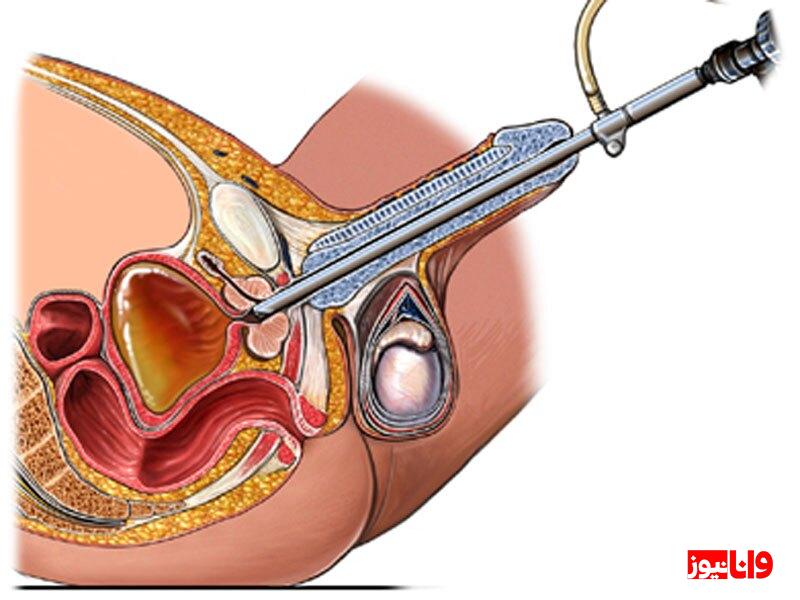 چه زمانی باید پروستات را عمل کرد؟ چه زمانی باید پروستات را عمل کرد؟
