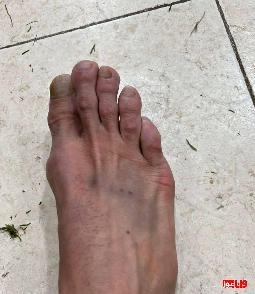 بلایی که در دربی بر سر بیرانوند آمد+عکس