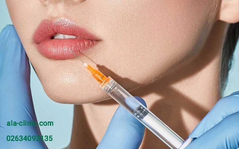 تزریق انواع ژل لب تزریق انواع ژل لب