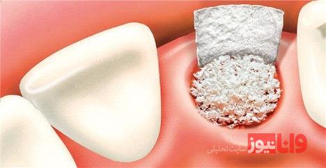 دندانپزشکان، پیوند استخوان برای ایمپلنت چگونه انجام می‌دهند؟