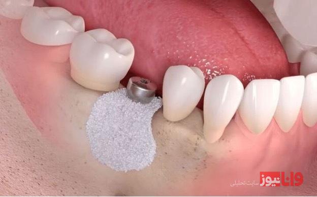 دندانپزشکان، پیوند استخوان برای ایمپلنت چگونه انجام می‌دهند؟