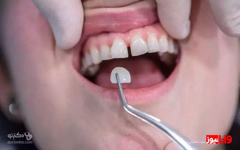 هزینه انواع لمینت دندان در دکترتو کلینیک در سال ۱۴۰۲ هزینه انواع لمینت دندان در دکترتو کلینیک در سال ۱۴۰۲