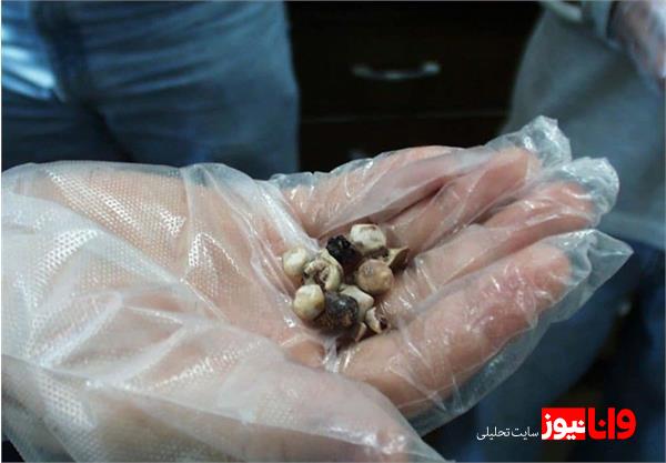 سنگ کیسه صفرا چیست و چه عواملی باعث ایجاد آن می شود؟ سنگ کیسه صفرا چیست و چه عواملی باعث ایجاد آن می شود؟