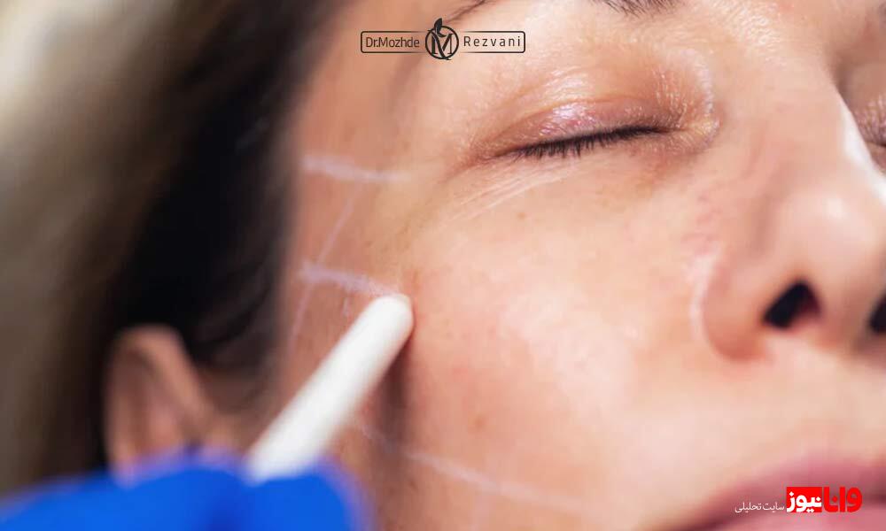 برای کاهش درد لیفت نخ شقیقه چه نکاتی را باید رعایت کرد؟ برای کاهش درد لیفت نخ شقیقه چه نکاتی را باید رعایت کرد؟