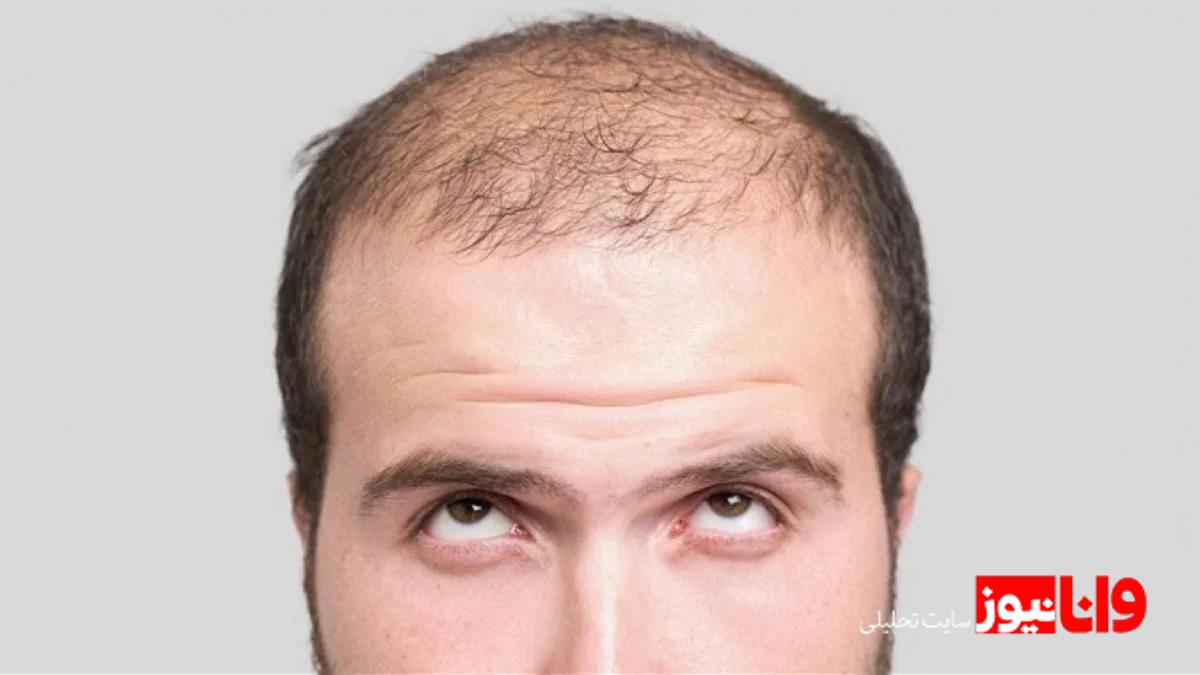 تحولی شگفتانگیز برای ظاهر شما با کاشت مو طبیعی! تحولی شگفتانگیز برای ظاهر شما با کاشت مو طبیعی!