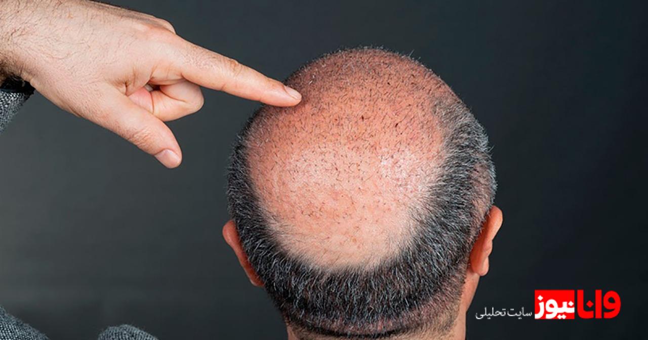 تحولی شگفتانگیز برای ظاهر شما با کاشت مو طبیعی! تحولی شگفتانگیز برای ظاهر شما با کاشت مو طبیعی!