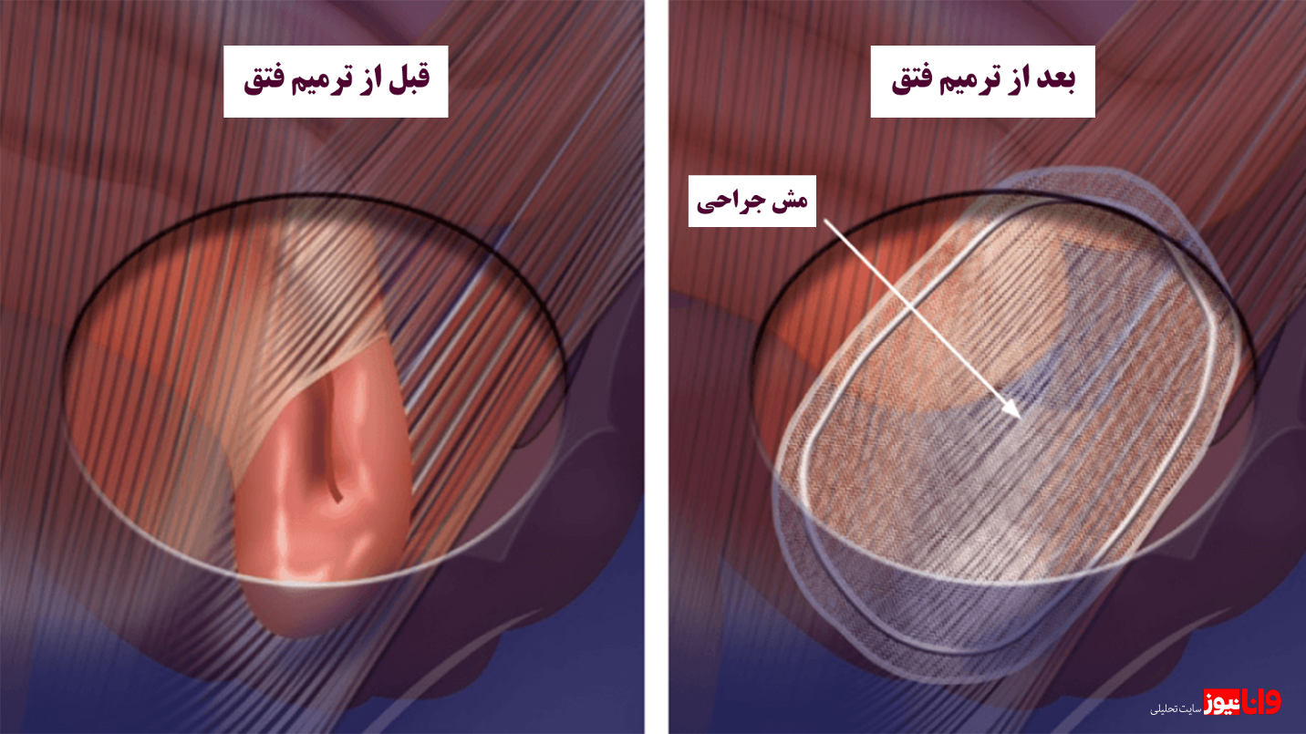 انواع فتق و راههای درمان آن انواع فتق و راههای درمان آن