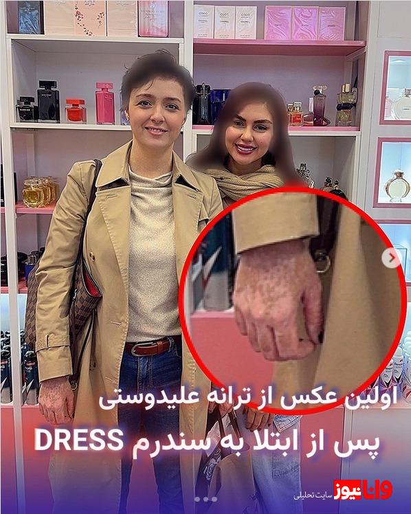ترانه علیدوستی به سرطان پوست مبتلا شده؟ سندرم DRESS چیست