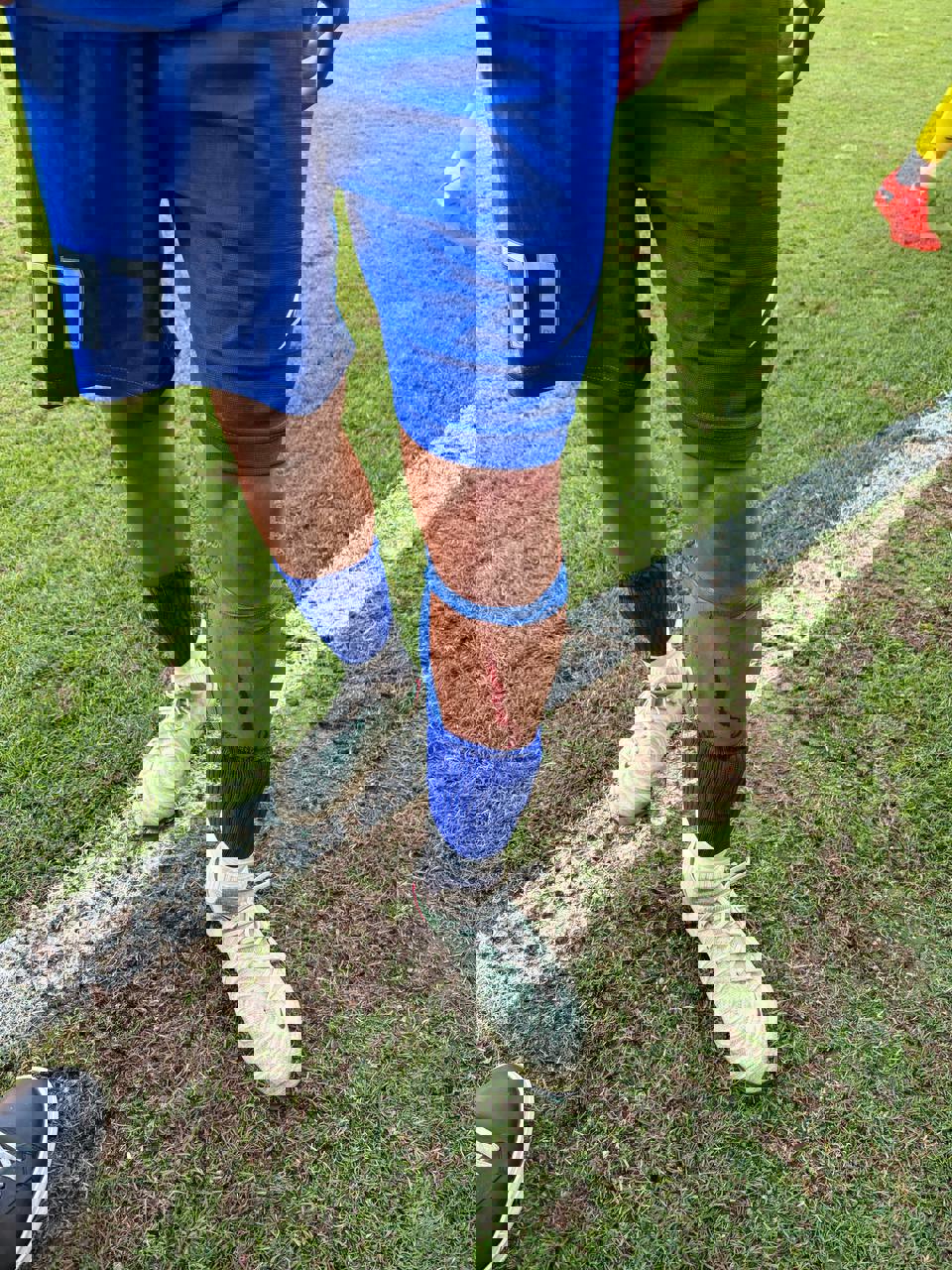 عکس | مدافع سابق پرسپولیس مضروب شد! عکس | مدافع سابق پرسپولیس مضروب شد!