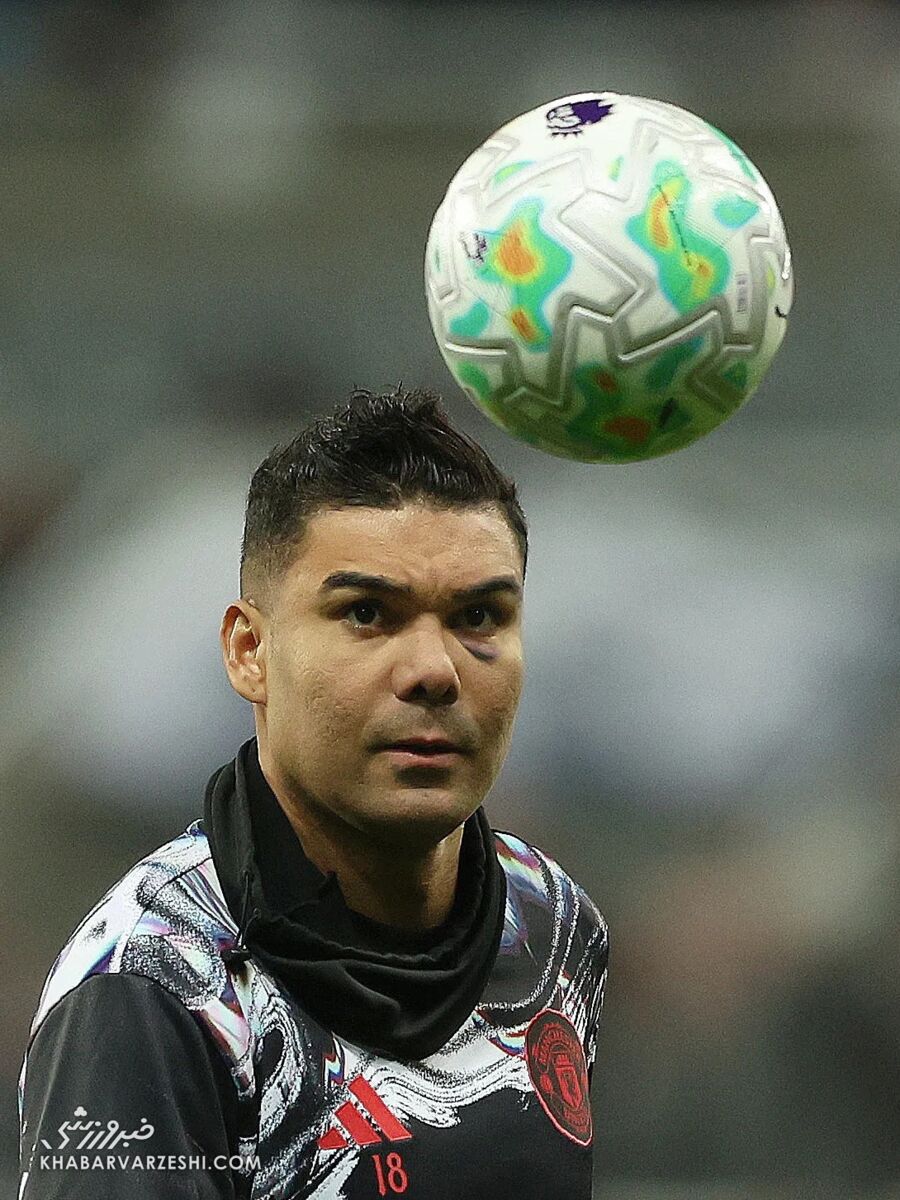 کبودی بزرگ روی گونه چپ کاسمیرو