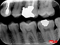 خدمات دندانپزشکی بیمه تکمیلی تامین اجتماعی