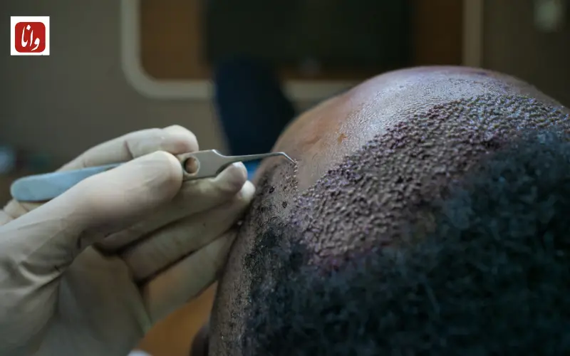 از علم تا زیبایی؛ روایت نو از آینده کاشت مو