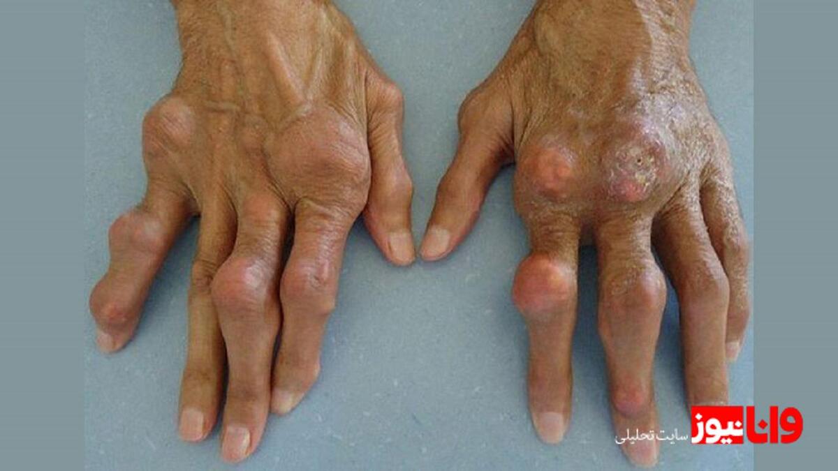 آیا بیماری نقرس خطرناک است؟