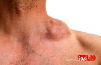 آیا سرطان غدد لنفاوی کشنده است؟