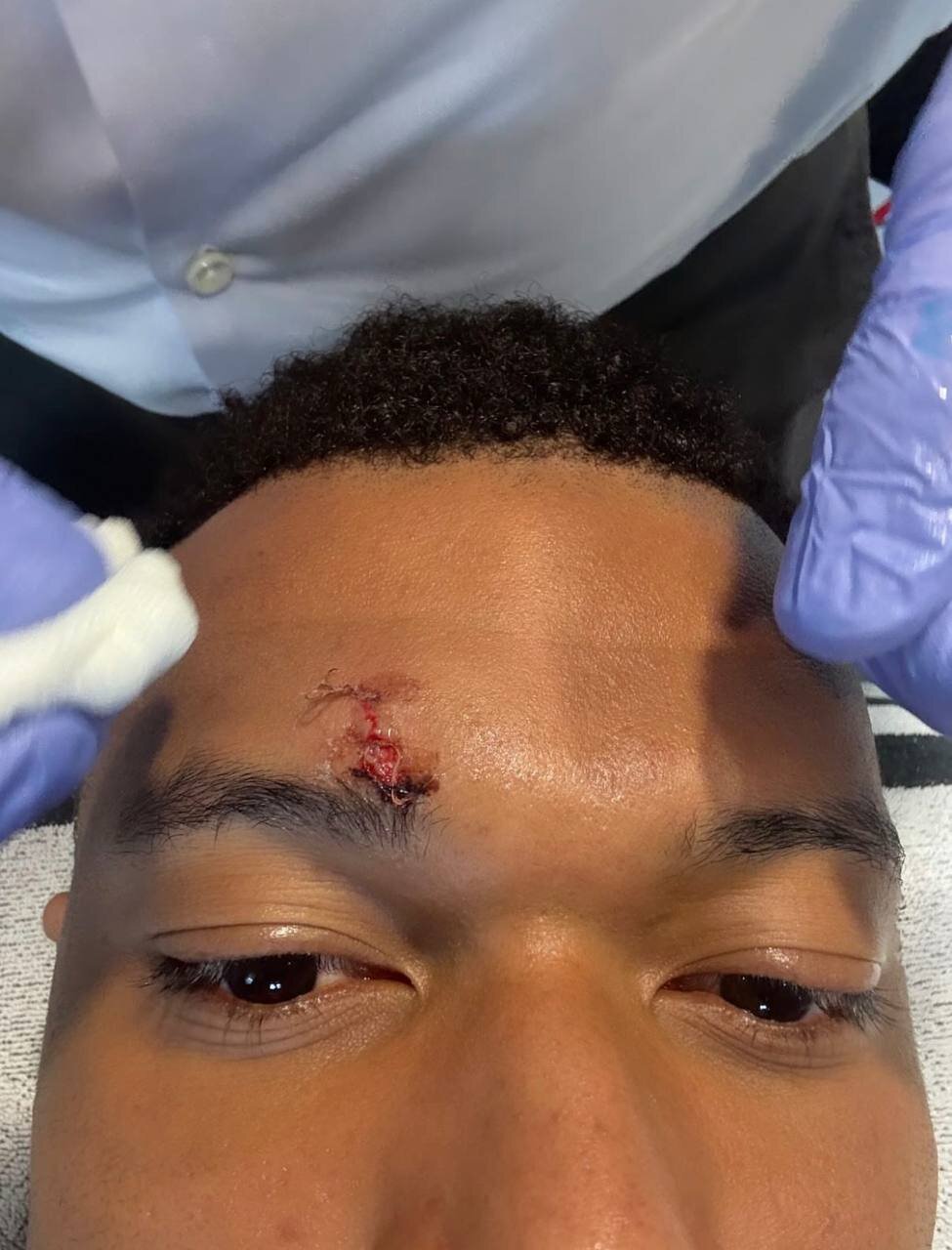 عکس | وضعیت نگران&zwnj;کننده امباپه؛ کار ستاره رئال به بخیه کشیده شد!