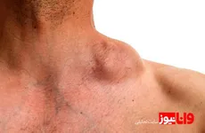 آیا سرطان غدد لنفاوی کشنده است؟