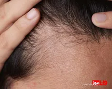 دستور جمع‌آوری یک مکمل تقویتی رشد مو