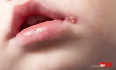 روش از بین بردن تبخال در یک روز