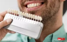 هزینه انواع لمینت دندان در دکترتو کلینیک در سال ۱۴۰۲