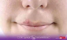 اگر بعد از تزریق ژل لب تبخال زدیم چه کنیم؟