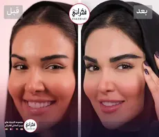 نگران مصنوعی شدن نتیجه کاشت ابرو هستید؟ تصاویر واقعی بیماران چند ماه بعد از کاشت را ببینید