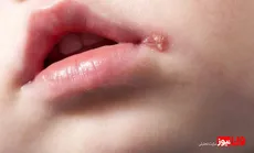 روش از بین بردن تبخال در یک روز